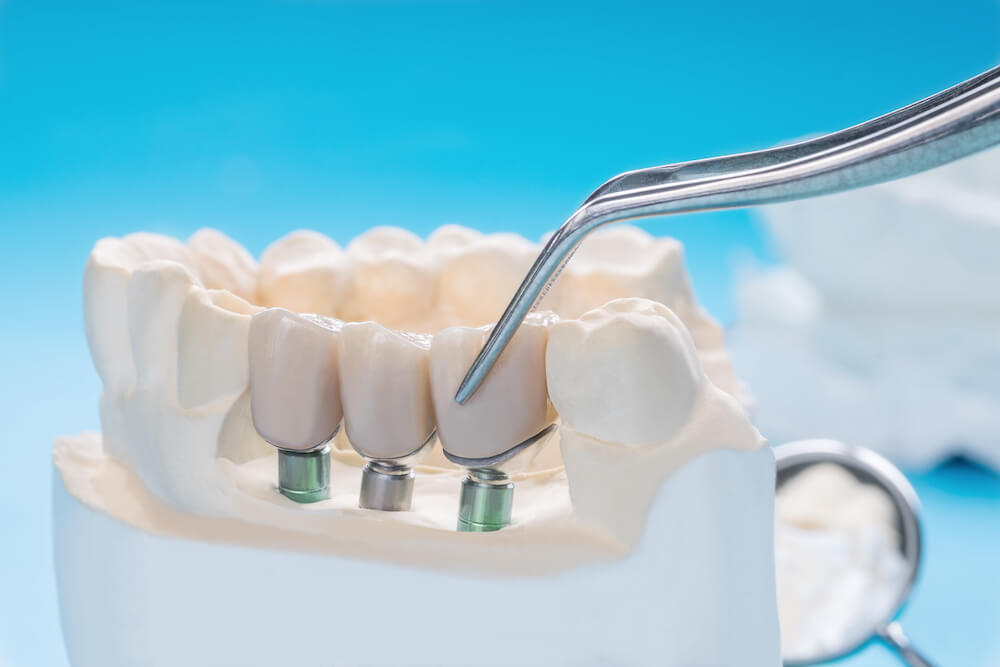 Implant Crowns Image